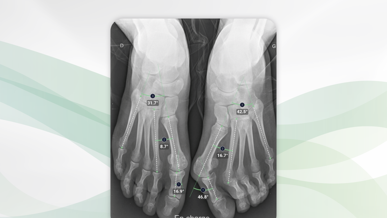 BoneviewMeasurements blog