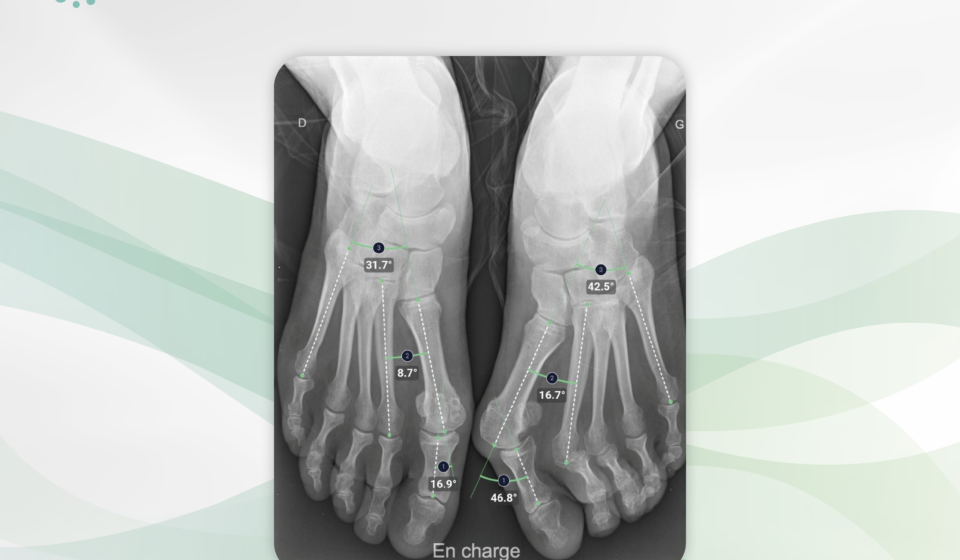 BoneviewMeasurements blog