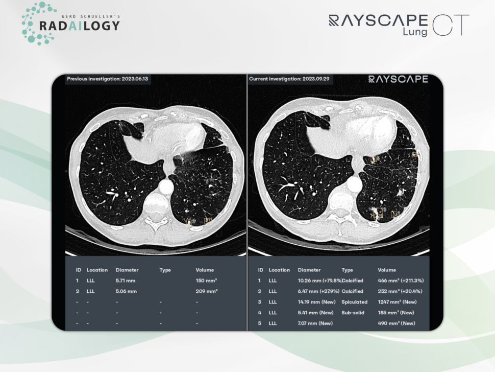 RayscapeLungCT