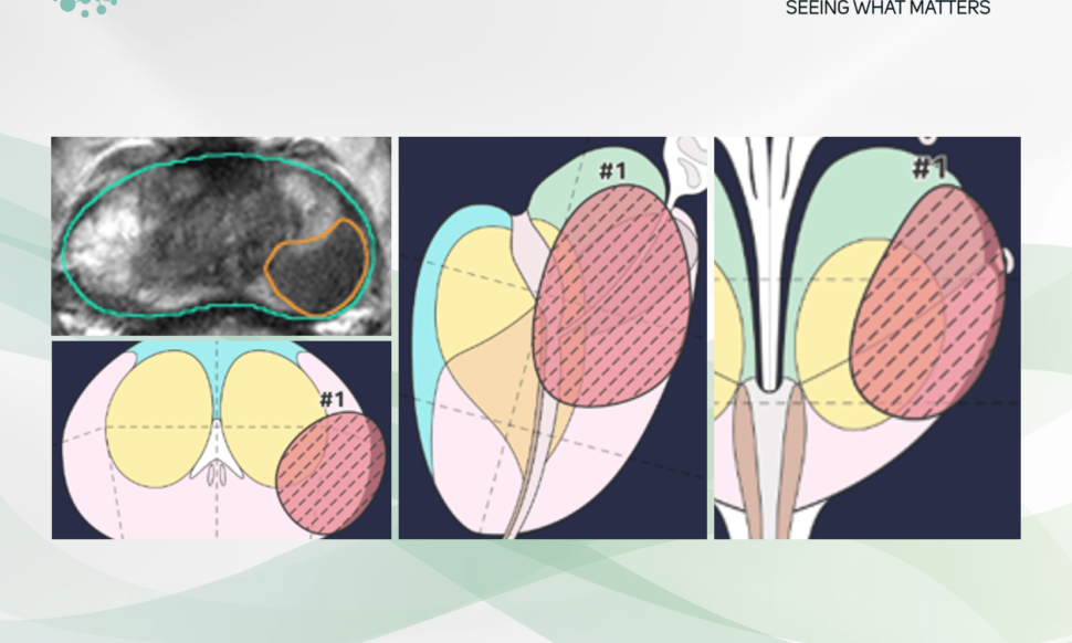 mdprostate 1