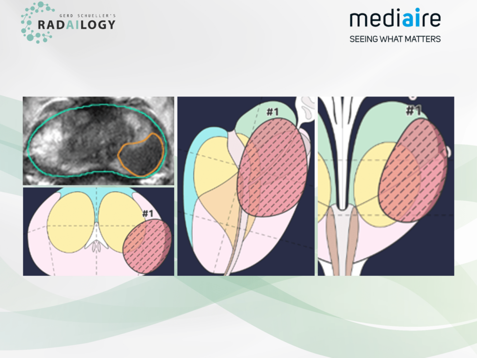 mdprostate 1