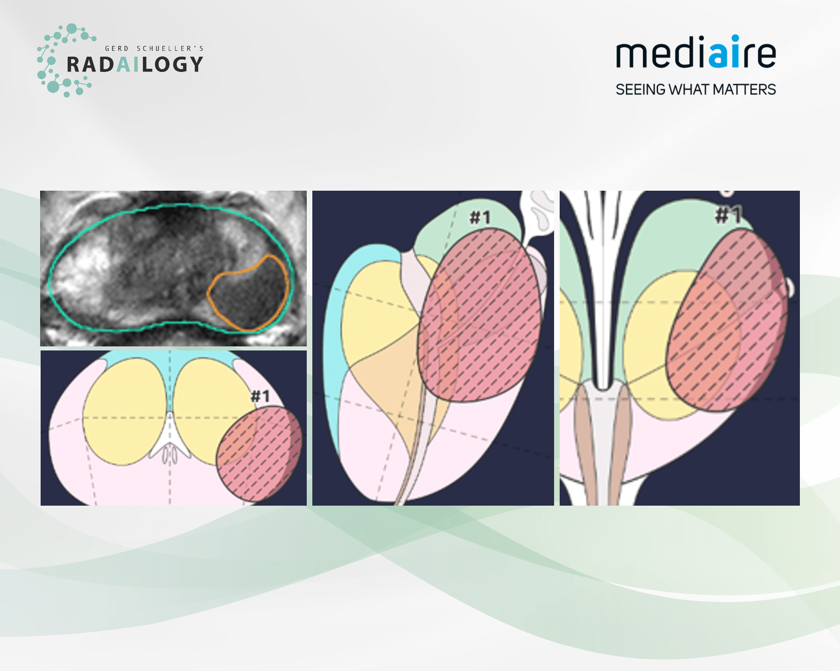 mdprostate 1