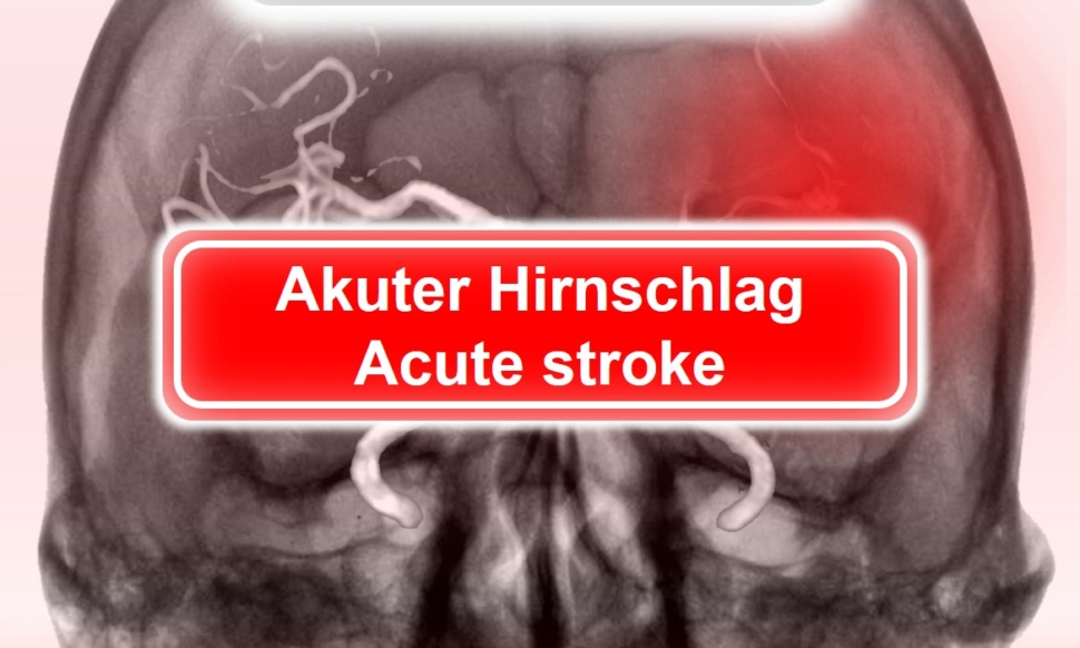 stroke 1